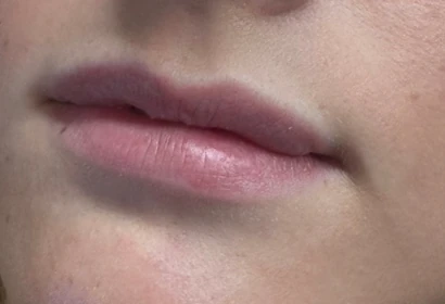 Lip fillers: before and after , before